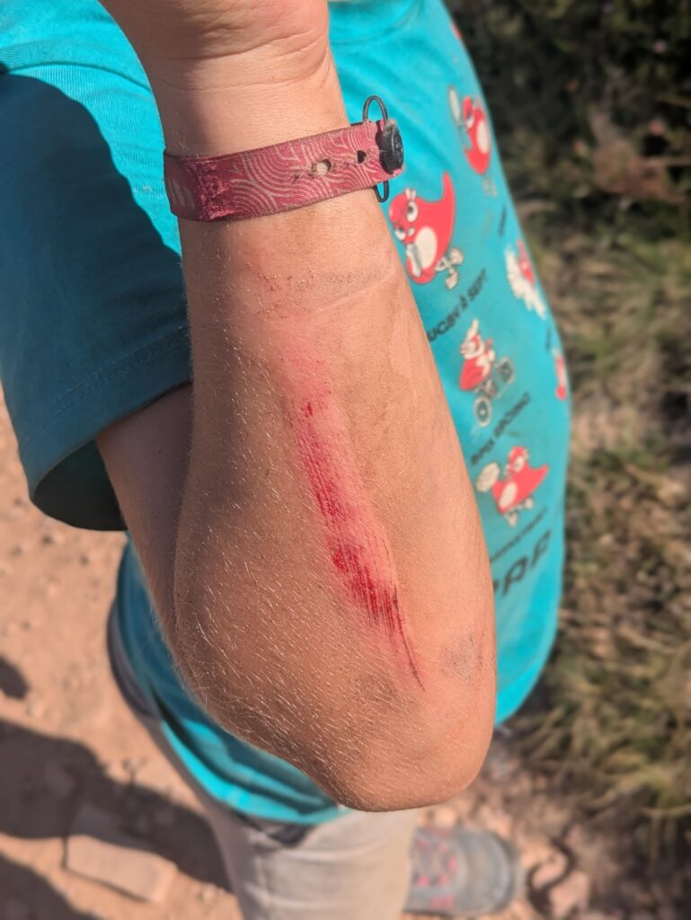 Gros plan sur le coude d’un enfant présentant plusieurs éraflures rouges après une chute en extérieur.